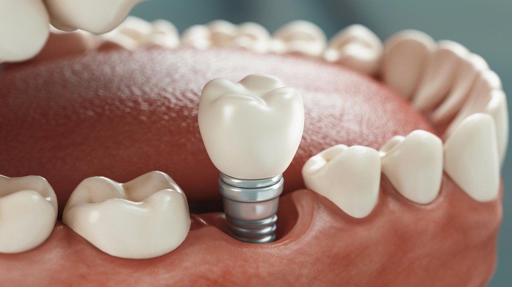 Dental Implants Harbor City, CA